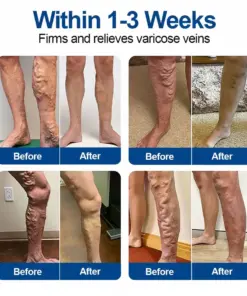 MHDLY® VeinEase Microneedle Care Patch